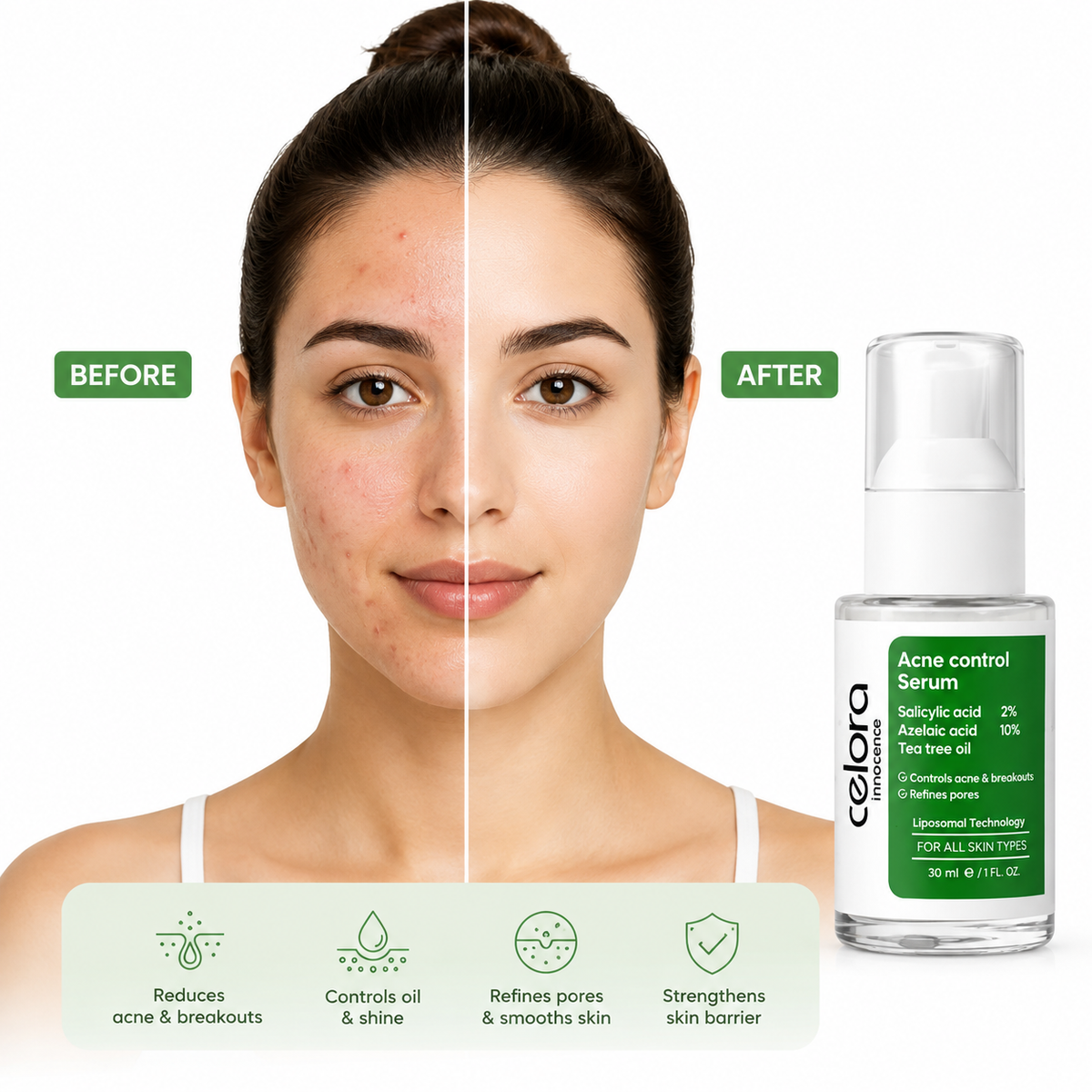 Celora acne treatment serum 30 ml
